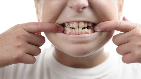 Teeth Aligners for Overbite, Underbite & Crowding: Do They Really Work?