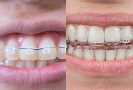 Ceramic braces vs clear aligners close-up comparison on teeth
