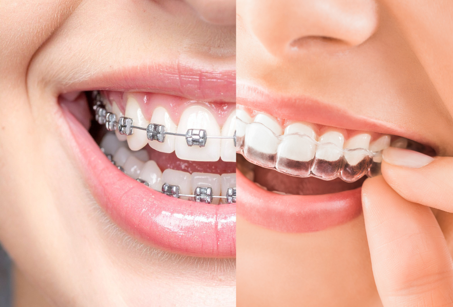 Clear aligners vs braces comparison – close-up of metal braces and transparent aligners on teeth