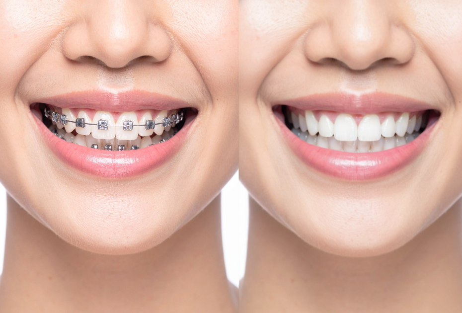 Before and after comparison of teeth straightening, showing braces treatment results and a gap-free smile.