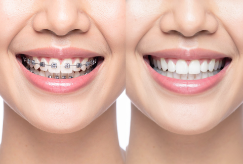 Clear Aligners vs Braces for Gaps: Which Option Is More Predictable?