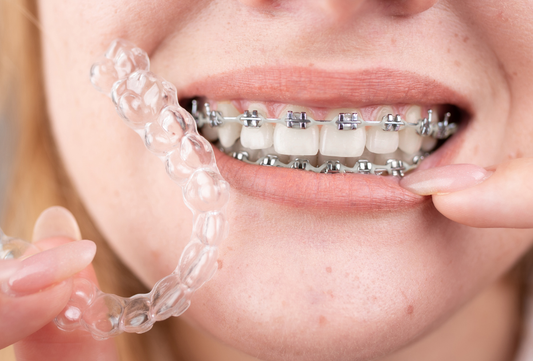 Clear Aligners vs Braces for Crowding: Which Works Better for Mild–Moderate Cases?