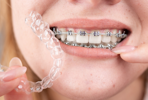 Aligners transparents ou bagues pour l'encombrement dentaire : quelle solution est la plus efficace pour les cas légers à modérés ?