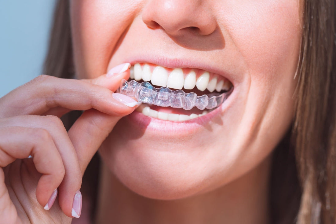 Why Smileie Clear Aligners Are a Game Changer for Teeth Straightening