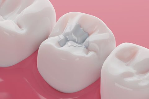 Understanding Tooth Decay: Causes, Prevention, and Treatment